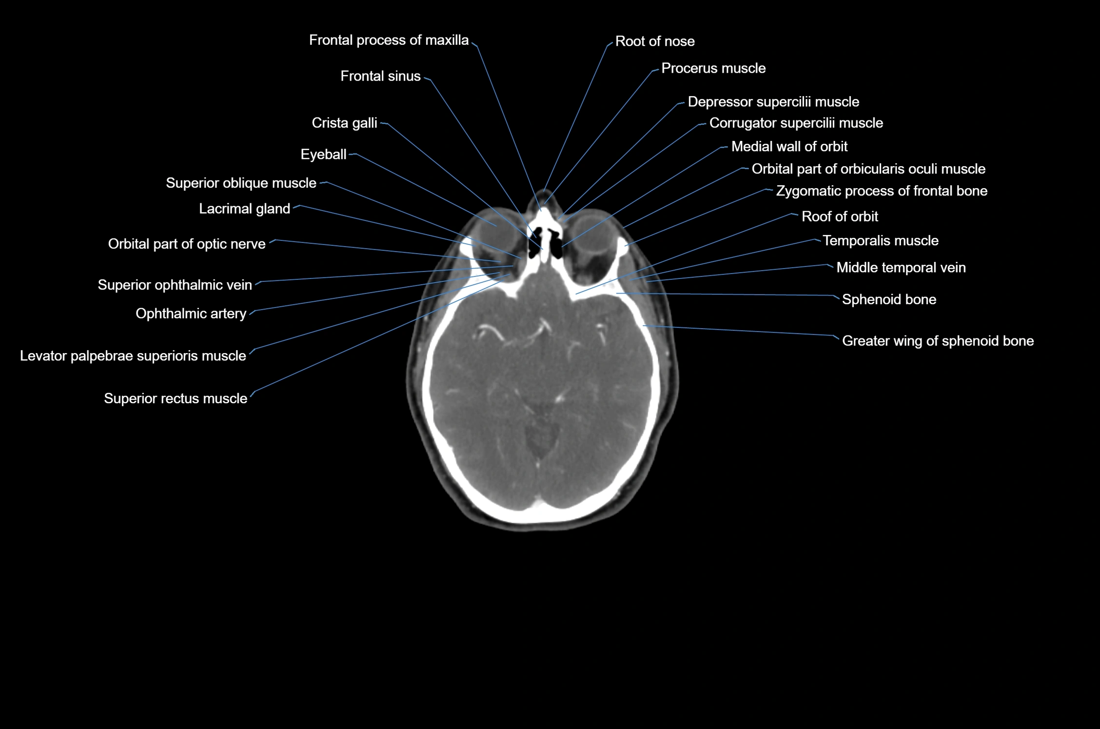 CT Neck axial cross sectional anatomy radiology image-img-00001-00004.webp